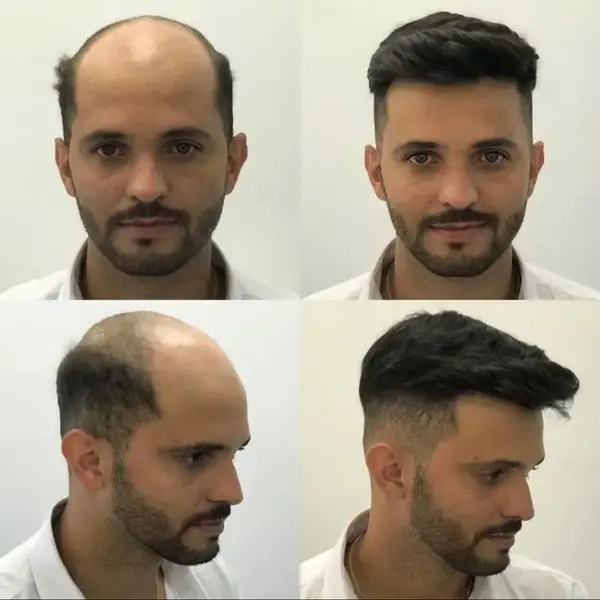 Antes y después de una prótesis capilar masculina, vista frontal y lateral