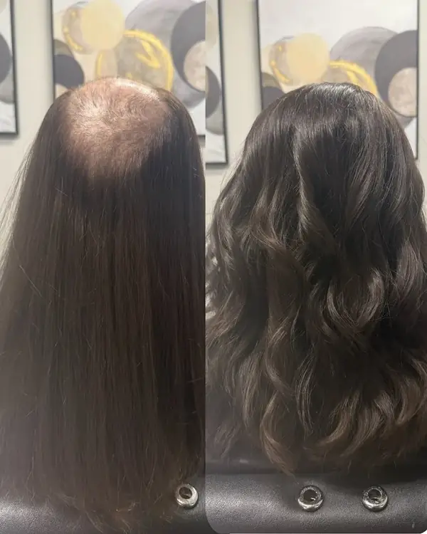 Antes y después de una prótesis capilar femenina, vista posterior