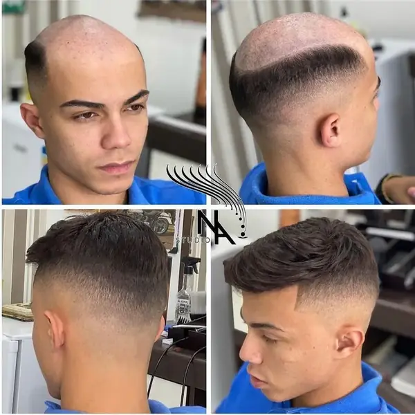 Antes y después de una prótesis capilar masculina en hombre joven, vista frontal, lateral y posterior