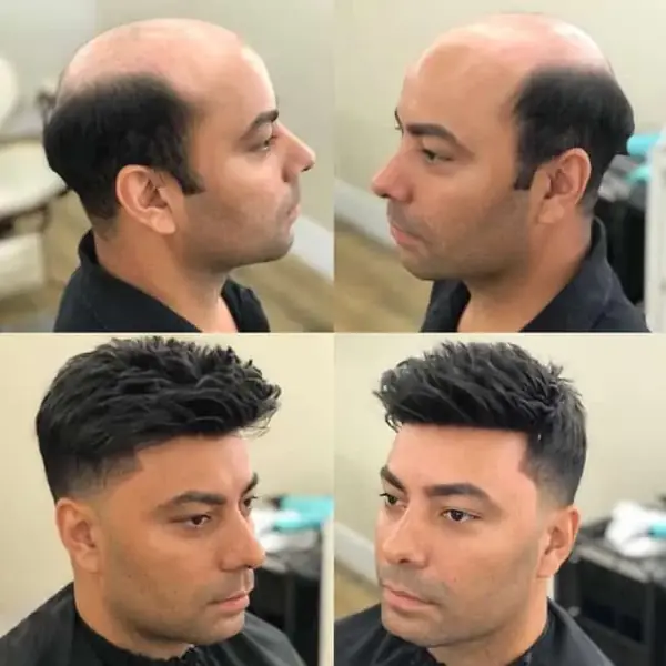 Antes y después de una prótesis capilar masculina, vistas laterales
