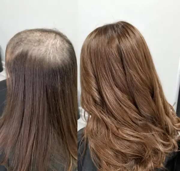 Antes y después de una prótesis capilar femenina, vista posterior