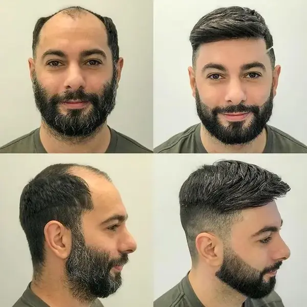 Antes y después de una prótesis capilar masculina, vista frontal y lateral