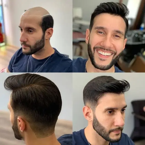 Antes y después de una prótesis capilar masculina, con el área marcada para el molde